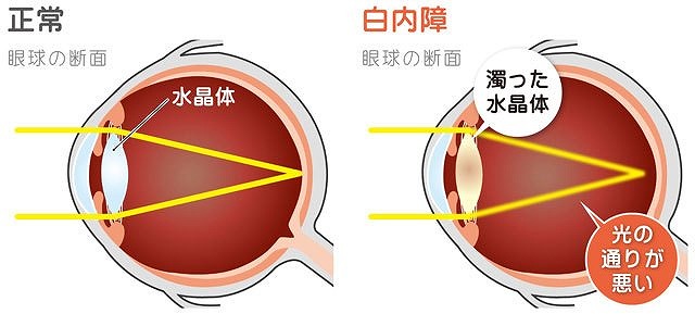 白内障の原因