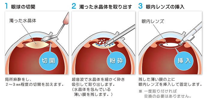 白内障の日帰り手術