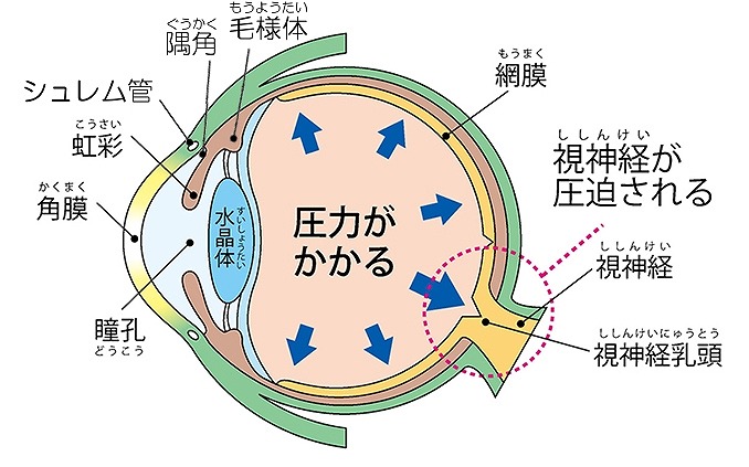 緑内障の原因