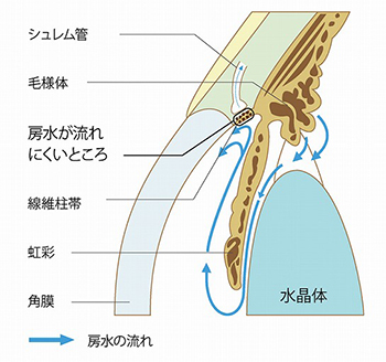 緑内障の原因