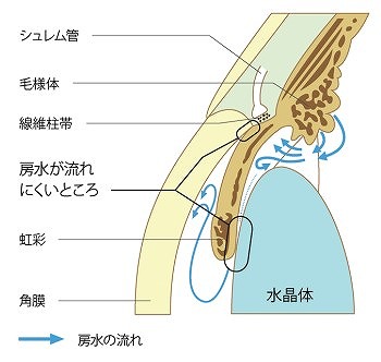 緑内障の原因