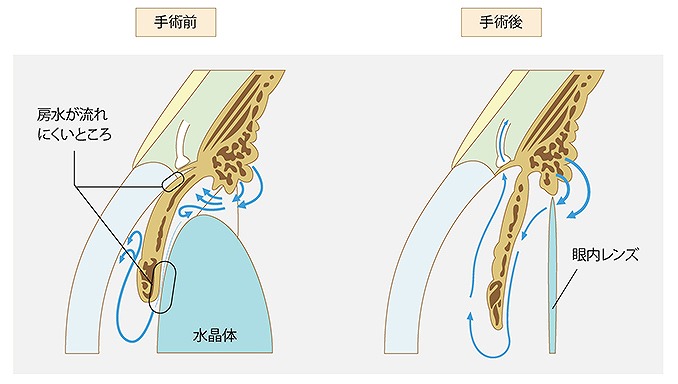 白内障緑内障同時手術