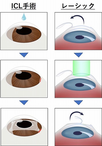 Icl手術 費用 眼内コンタクトレンズ 北浦和眼科 埼玉 さいたま市
