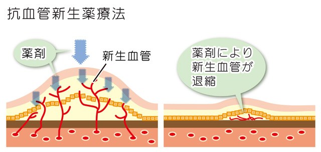 硝子体注射