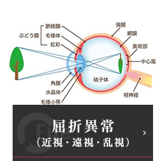 屈折異常（近視・遠視・乱視）