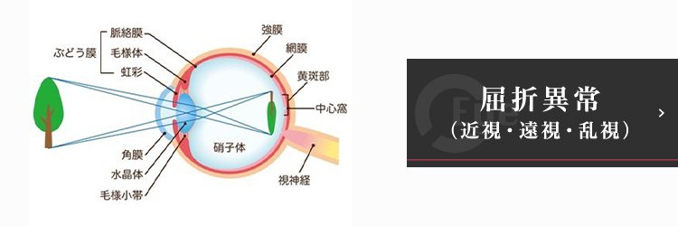 屈折異常（近視・遠視・乱視）