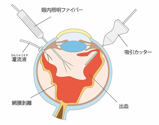 硝子体手術とは