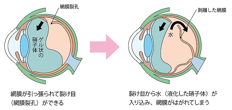 裂孔原性網膜剥離