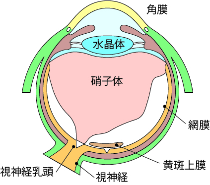 黄斑前膜（黄斑上膜）